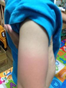 sunburn arms